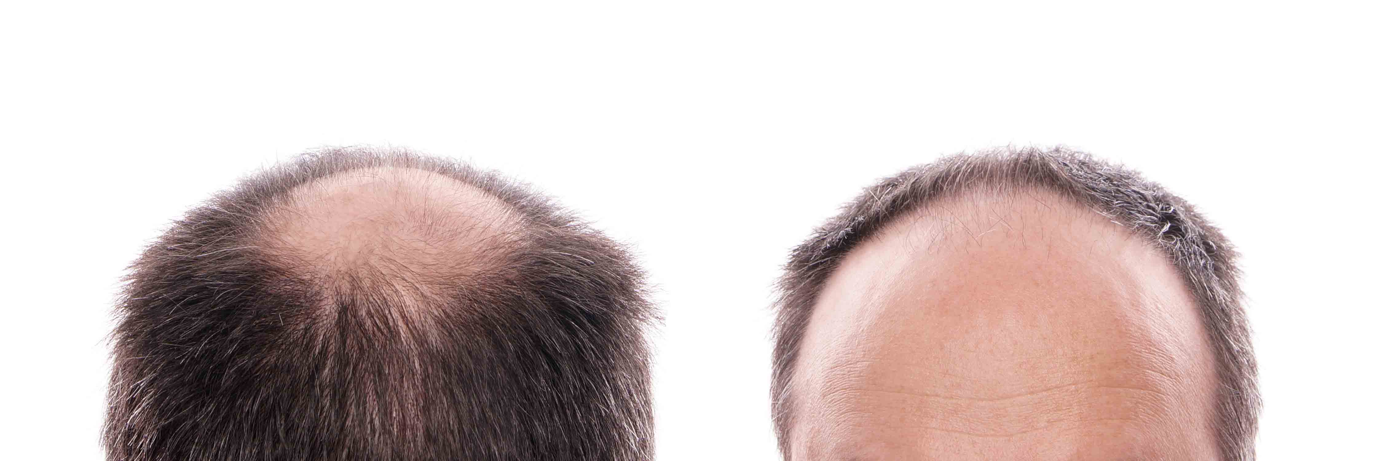 ¿Una quemadura solar en el cuero cabelludo, puede producir alopecia?